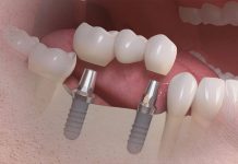 Czym różni się protetyka na implantach od mostów stomatologicznych?